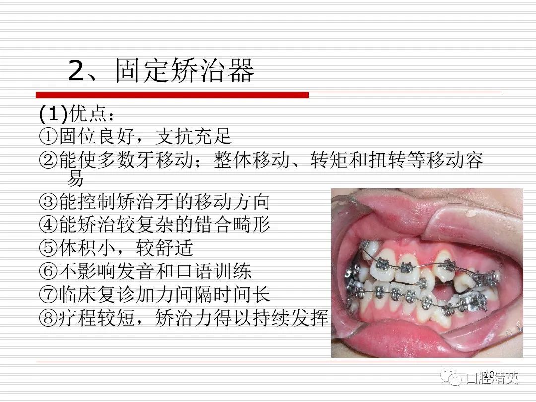 正畸最新技术，引领牙齿矫正新时代的革新先锋
