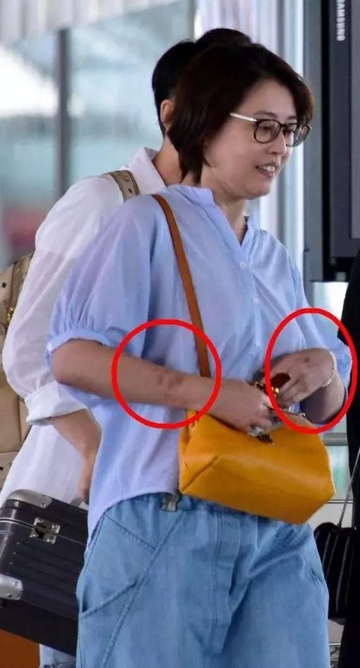 #红斑狼疮为什么是不死的癌症#