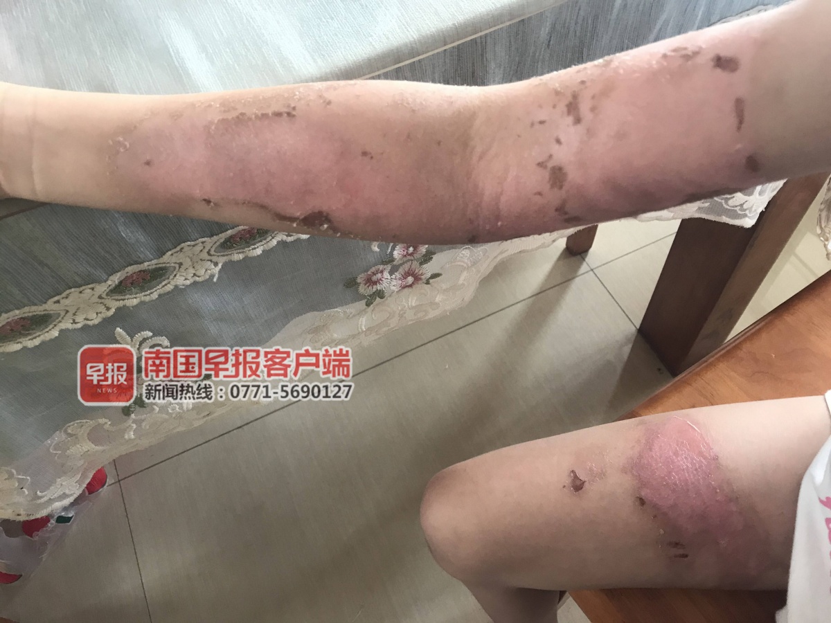 女童遭高年级男生泼水烫伤事件，校方的回应与社会关注焦点