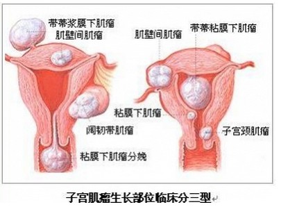 子宫肌瘤最新最佳治疗方法，科技重塑健康之路的突破探索