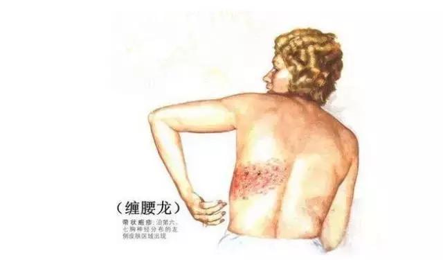 带状疱疹后遗神经痛最新治疗方法探索，小巷深处的神秘之旅