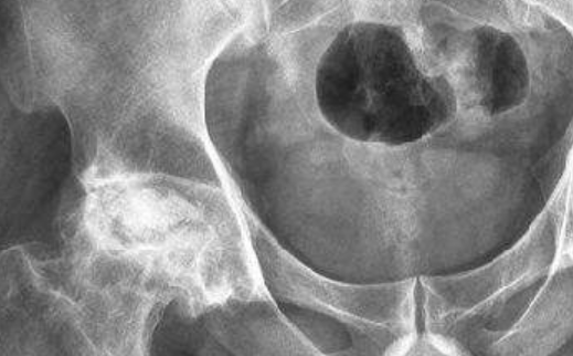 股骨头坏死最新治疗方法，小巷深处的医学奇迹探索