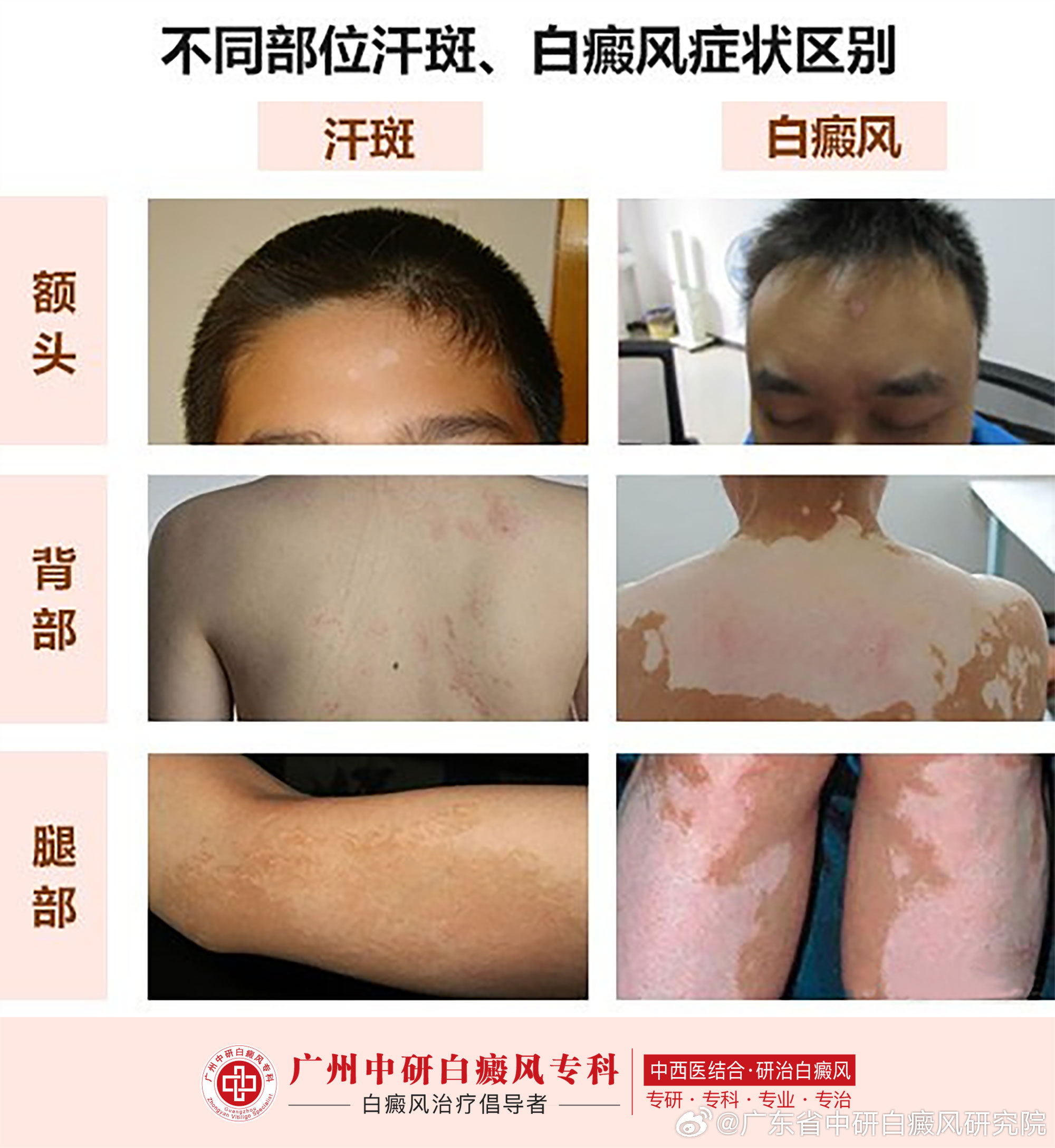 白癜风最新科学治疗新纪元探索，带你走进治疗的新纪元！